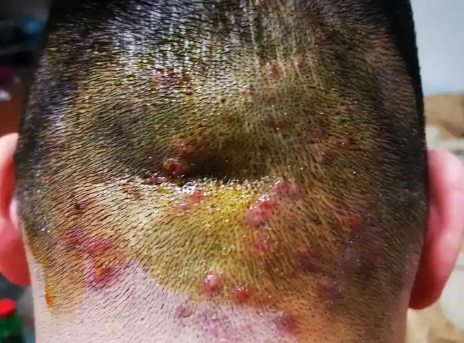 头上长红疙瘩毛囊炎是一种常见的头皮皮肤疾病,主要表现为头皮上出现