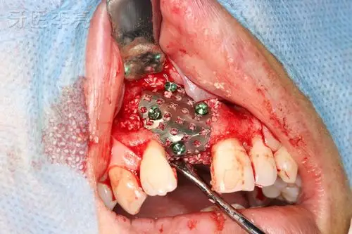 钛网骨增量 - 美篇