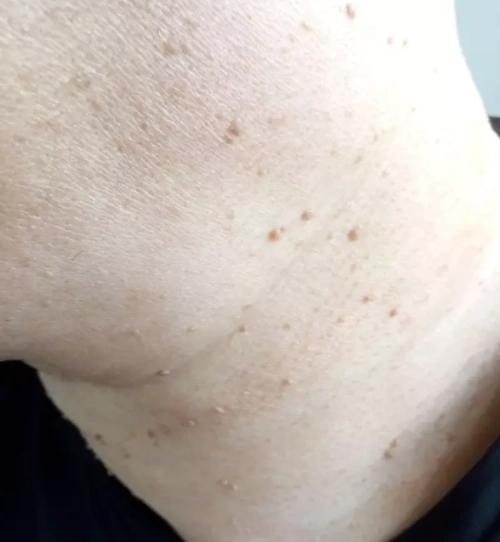 丝状疣会不会传染_疣_介绍_治疗方式 - 好大夫在线