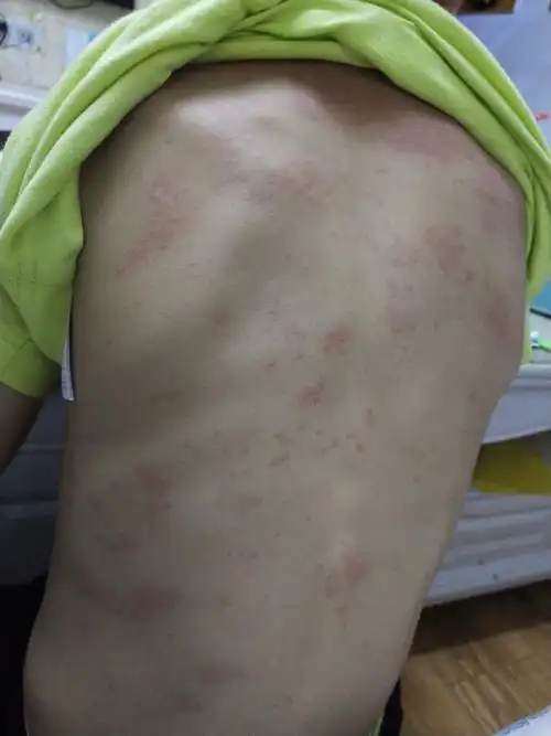 小孩急性荨麻疹,求有经验的妈妈推荐医院和医生