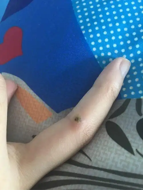 手上长的瘊子怎么治疗