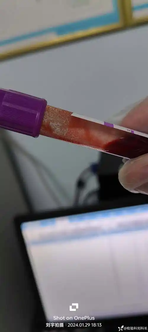 丁香园论坛>临床检验>帖子详情>解决冷凝集问题的方法