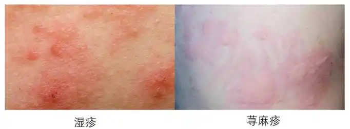 敲黑板湿疹和荨麻疹的异同需注意区分