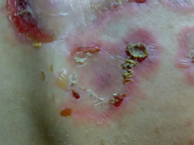 水疱糜烂 - 皮肤及性传播疾病讨论版 - 爱爱医医学论坛 - 爱爱医医学