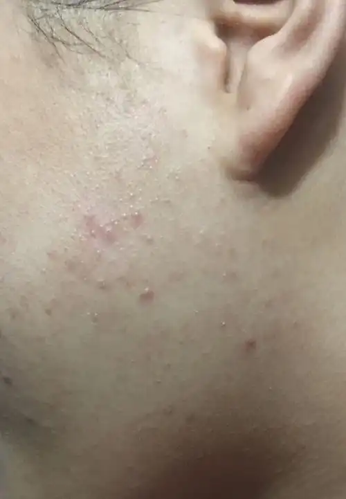 脸上有一层密密麻麻的痘痘这是什么?是闭口吗?