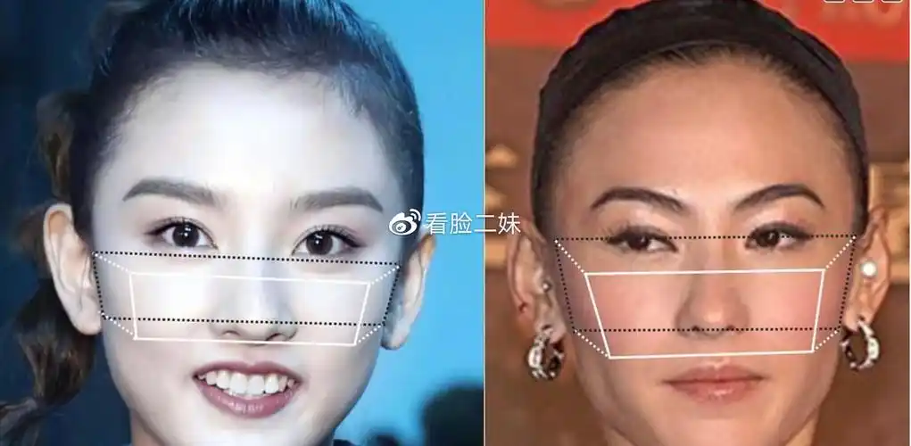 图解对比,让你三分钟知道颧骨高和颧骨外扩的区别是什么?