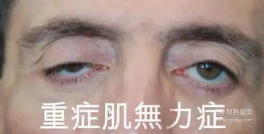 重症肌无力的早期症状有哪些