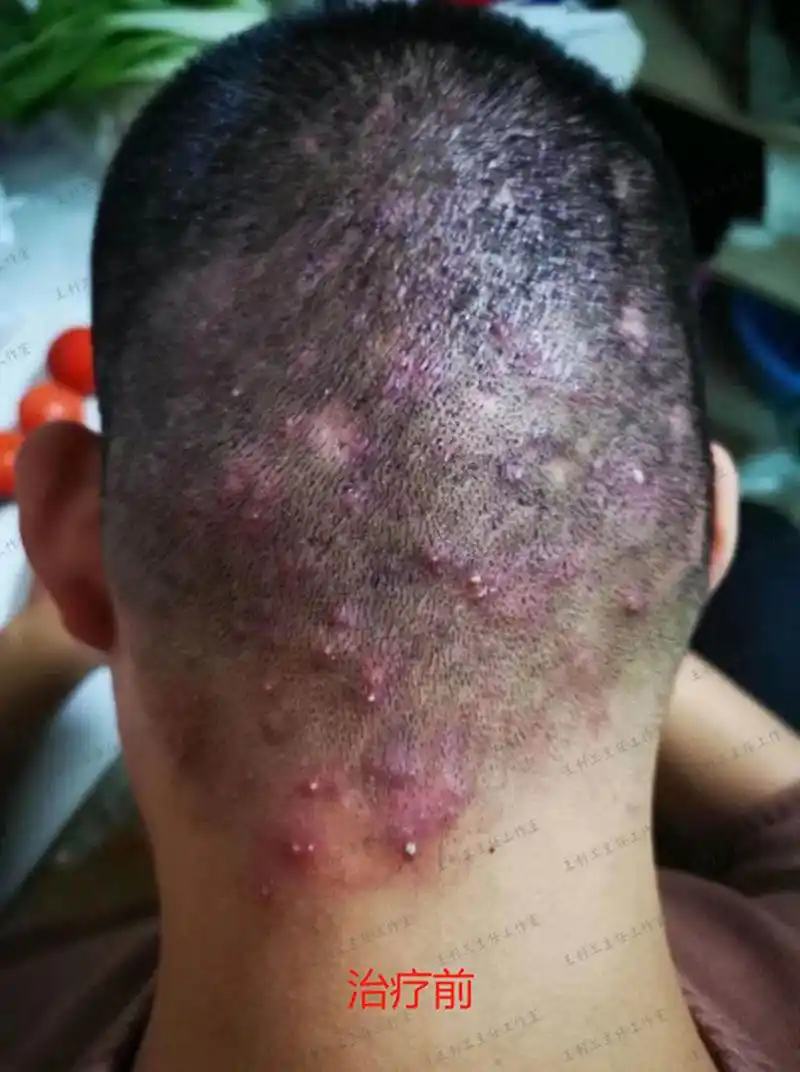 找准问题 对症施治 消退顽固毛囊炎 一个方子足够了  毛囊炎症在表病