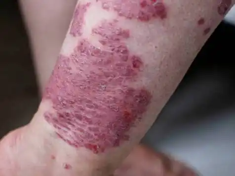 湿疹的皮肤问答你知道多少?