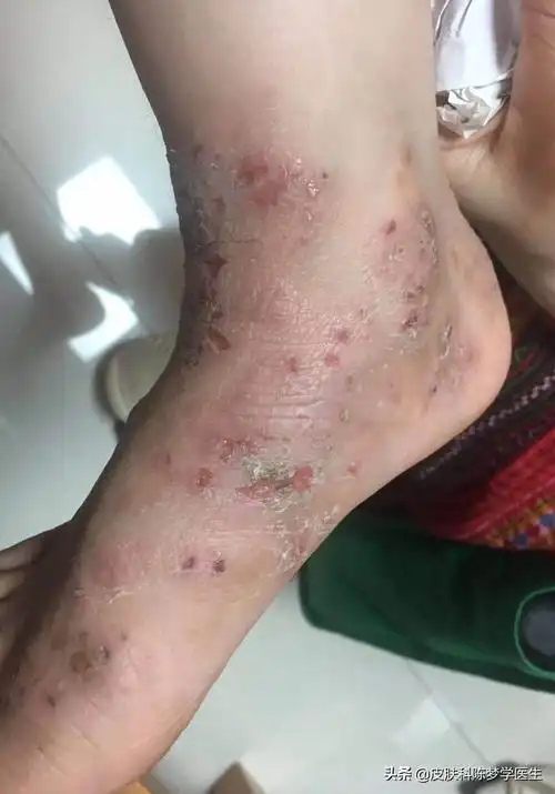 湿疹,能不能治得好?