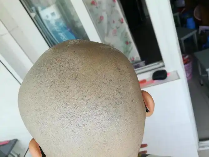 5光头第五天,刮破的地方还没好呢