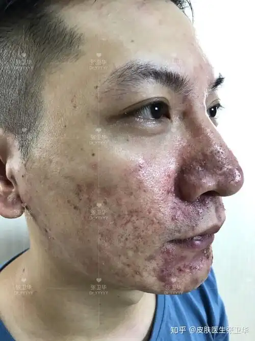 这个痘坑患者皮肤有些严重啊