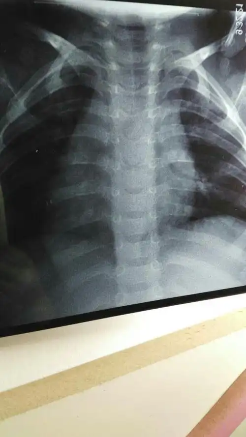 两岁小孩两个月来反复感冒鼻塞咳引起支气管肺炎住,现在又鼻塞咳嗽