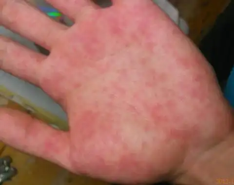 患者信息:男 22岁 福建 宁德  病情描述(发病时间,主要症状等): 手掌