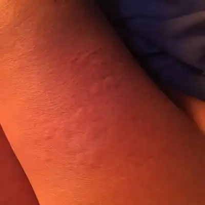 生完孩子后,腿上长了很多疙瘩,特别痒,挠起来一片