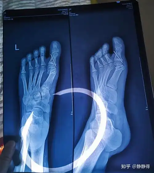 拇外翻(大脚骨)截骨手术后半年 - 知乎