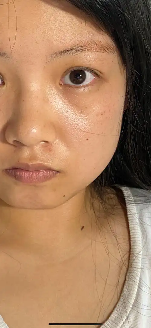 皮肤毛孔大出油