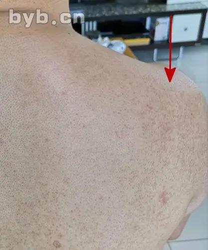 年青人长痘中年人长斑说明啥