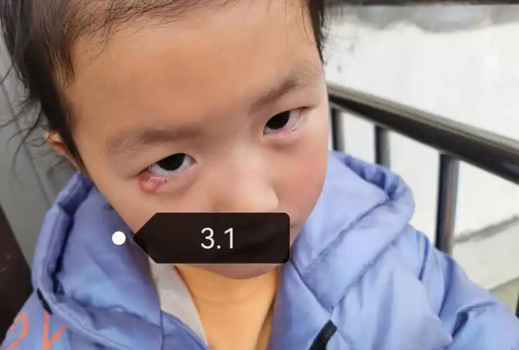 4岁女宝宝霰粒肿