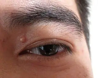 请问上眼皮外面长了个颗粒状东西是什么