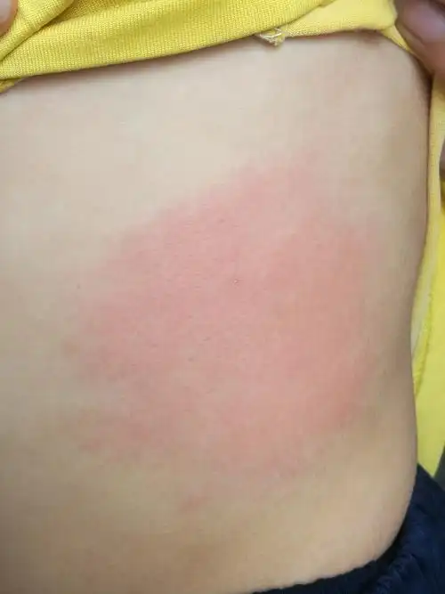 水过敏?千奇百怪的荨麻疹!