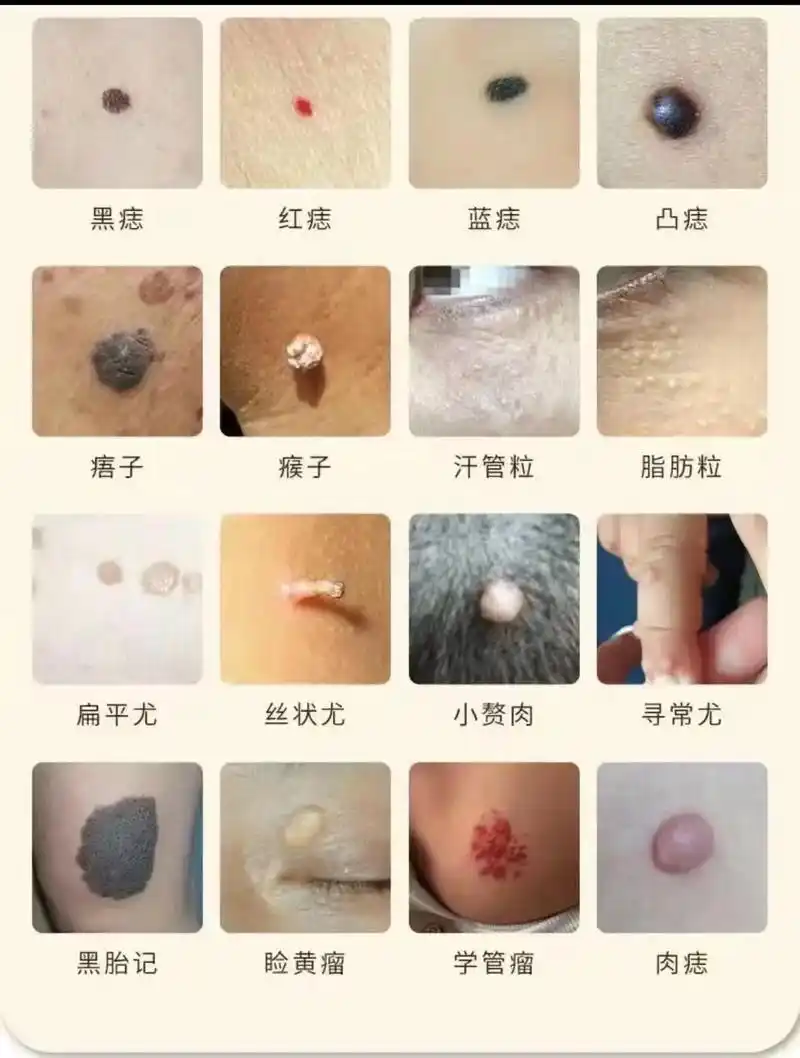 脸黄瘤 丝状尤 红痣 痞子 凸痣 肉痣 黑痣 丝状疣 脂肪粒 - 抖音