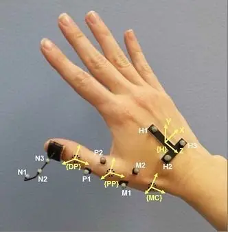 腕管综合症会减弱大拇指对掌和环转运动