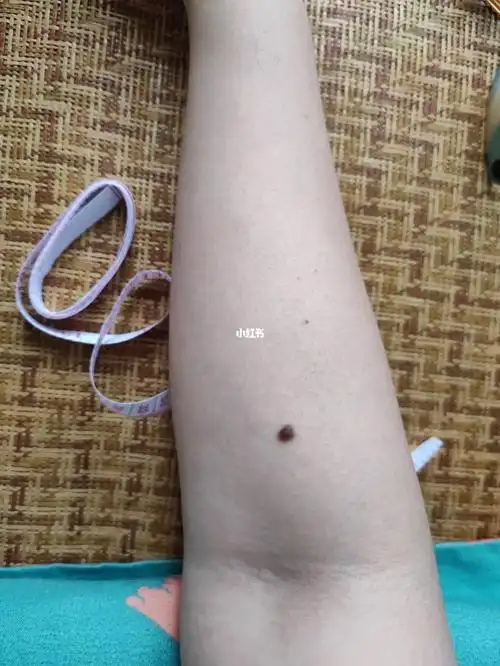 右胳膊5毫米的大痣要不要去切除啊