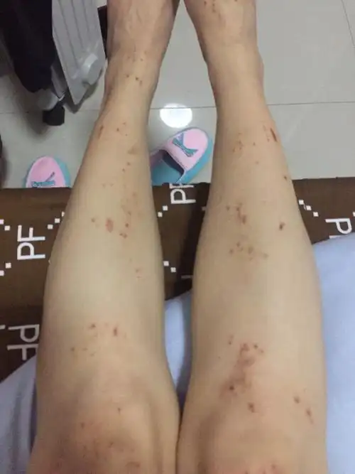 我怀孕7个月多了,现在身体到处痒,一抓就是一个疙瘩,晚上睡不好觉