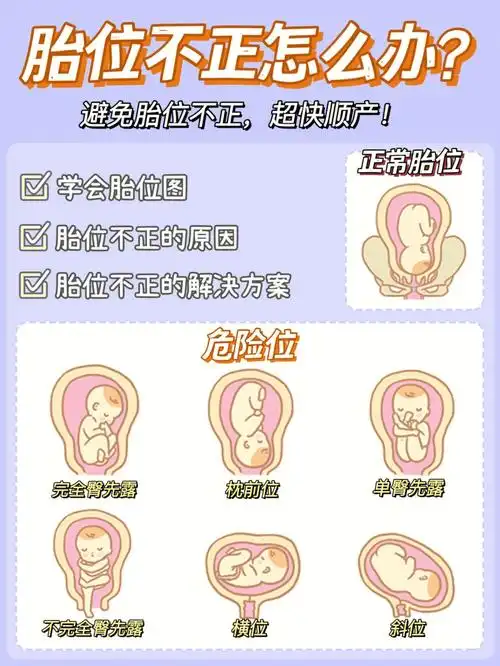 胎位不正应该怎么纠正教你学会看胎位图
