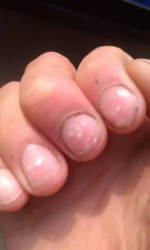 本人干修车 指甲有白点是为啥么求解
