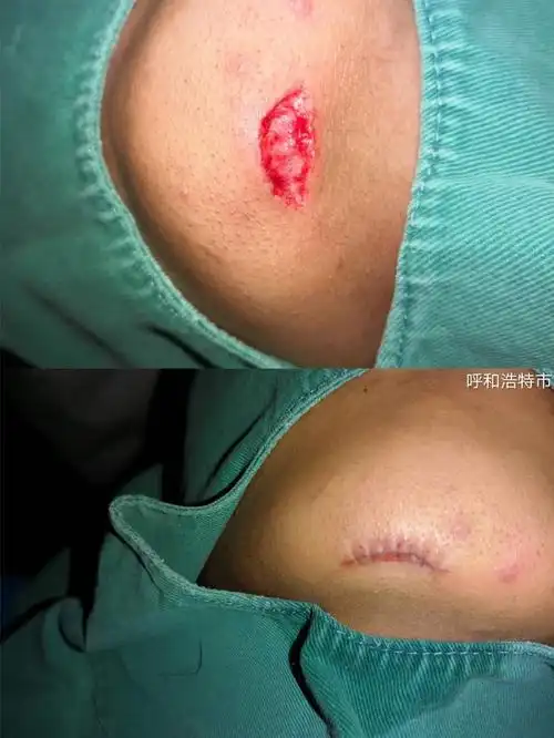 美容缝合那些事