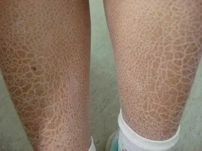 皮肤损害象"鱼鳞"或"蛇皮"样,呈多角形或菱形,中间附着,边缘上翘,小腿