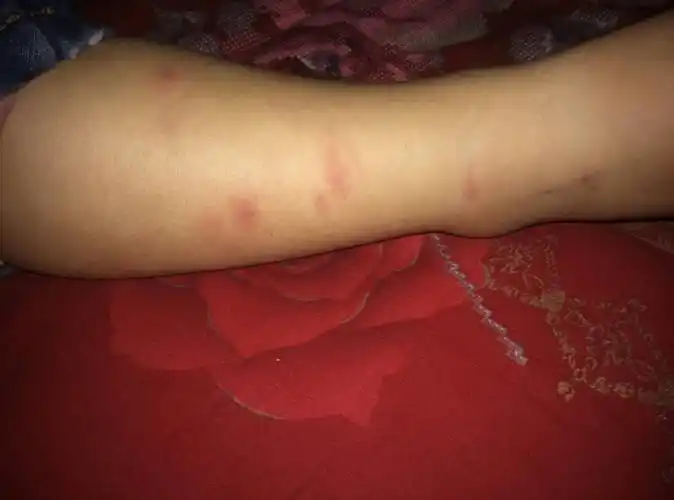 宝宝身上起红包,很痒,越起越多,怎么回事,去医院医生说观察一天是不是