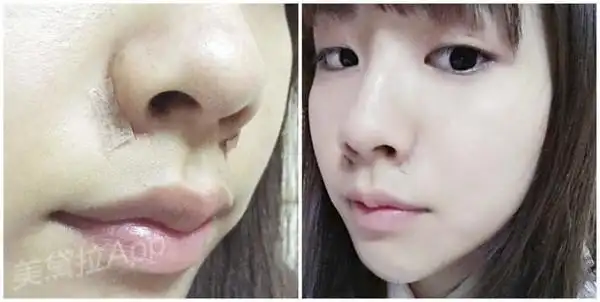 埋线缩鼻翼不着痕迹提升萌妹力