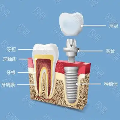 通州区老年种牙有哪些医院揭秘北京通州哪里种植牙比较好