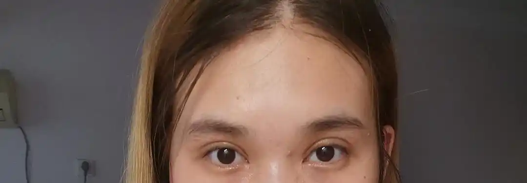 双眼皮20天 一宽一窄 不知道还能恢复吗