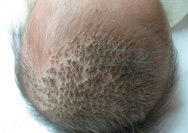 头癣的症状图片 (55)