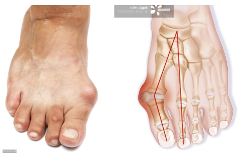 请保护你的孩子远离"大脚骨"!