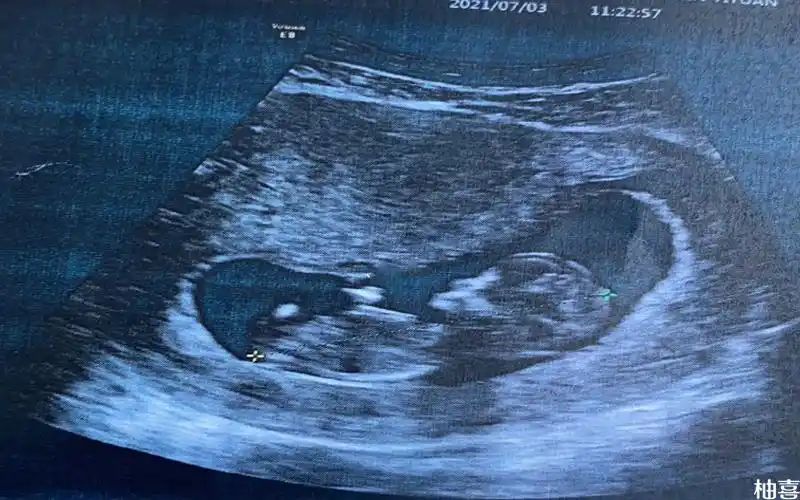 nt图像上有三个点是怀女孩的概率更高吗?