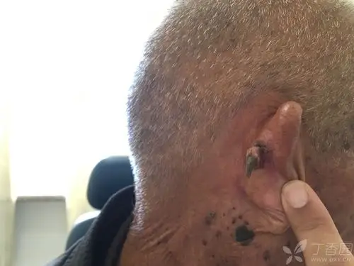 1年 体格检查:右侧耳后可见角状突起 辅助检查: 临床诊断:耳廓肿物