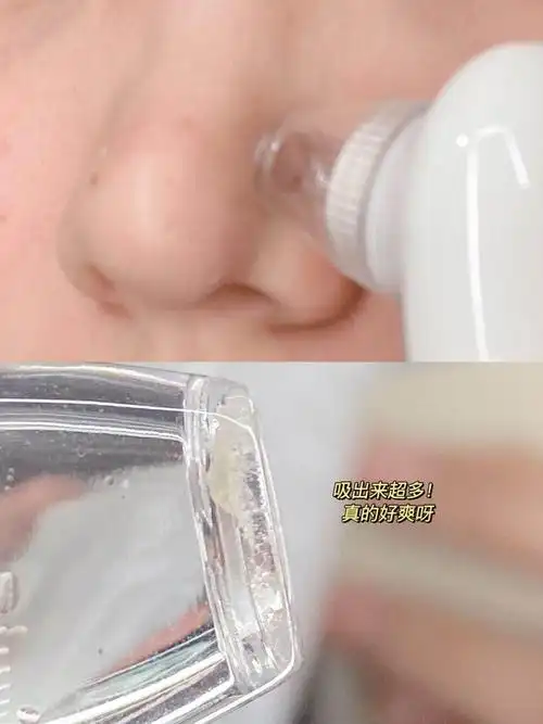 还在美容院去黑头吗超人气平价levetop黑头仪把小气泡搬回家