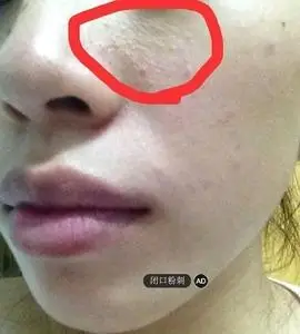 祛闭合粉刺精华液 去黑头白头闭合粉刺油脂粒脂肪粒痘痘粉刺痘印