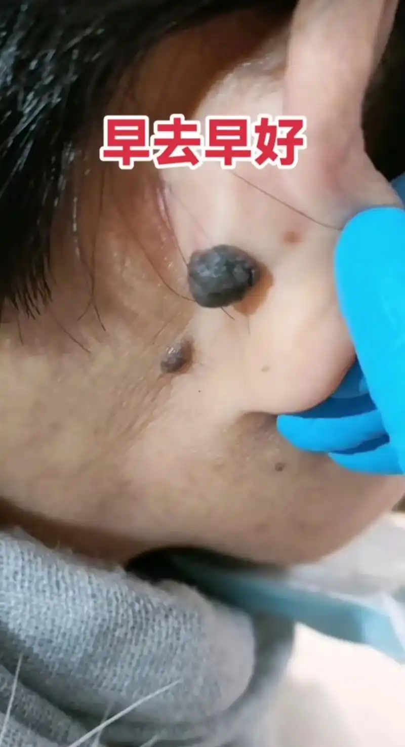 黑色素痣 #不辜负每一份信任  凡是皮肤凸起的黑色素肉痣会 - 抖音