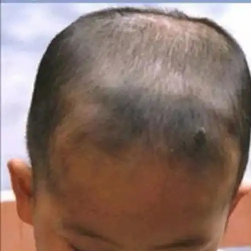 【南阳市儿童医学中心 儿二科 张龙】,小儿佝偻病你了解多少呢?