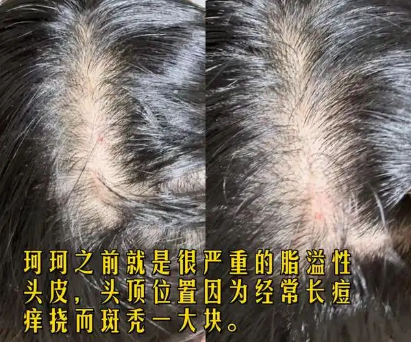 脱发|蜂毒|头皮屑|皮肤