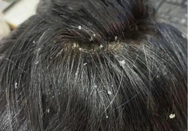 女朋友说我头上头皮屑多,看着恶心,该怎么改善?