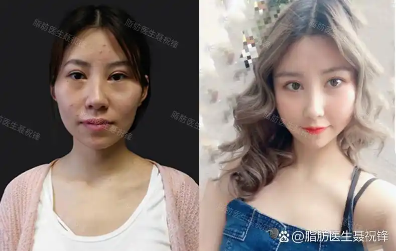 一个月前做过脂肪填充的求美者发来一组恢复照片,现在基本上已经都