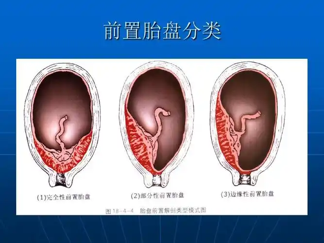前置胎盘分类