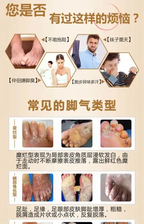 喷脚王狼毒脚气王脚气止痒